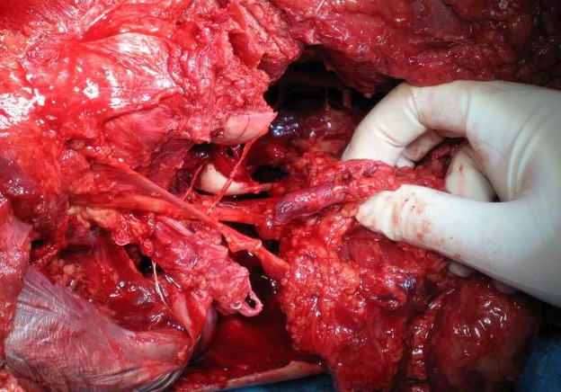 Popliteal Artery transection 1